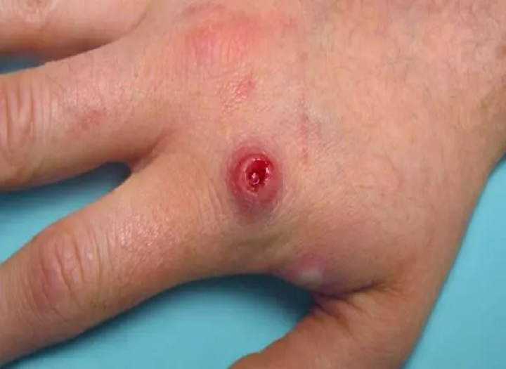 Monkeypox 이해와 그것을 예방하는 방법？
